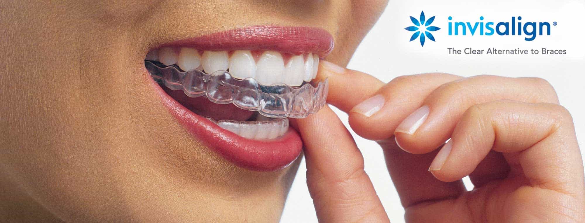 Invisalign-Tab