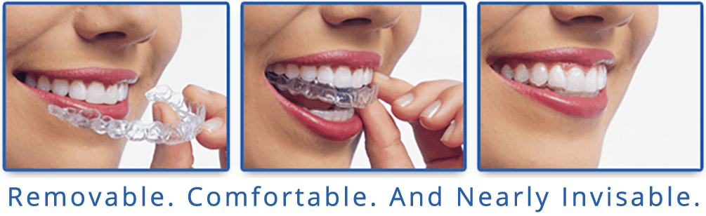 invisalign-clear-braces-guildford-orthodontics-surrey